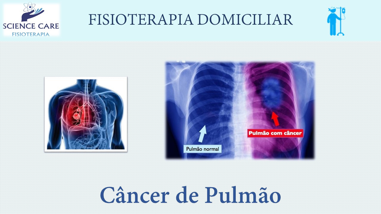 Câncer de pulmão fisioterapia domiciliar