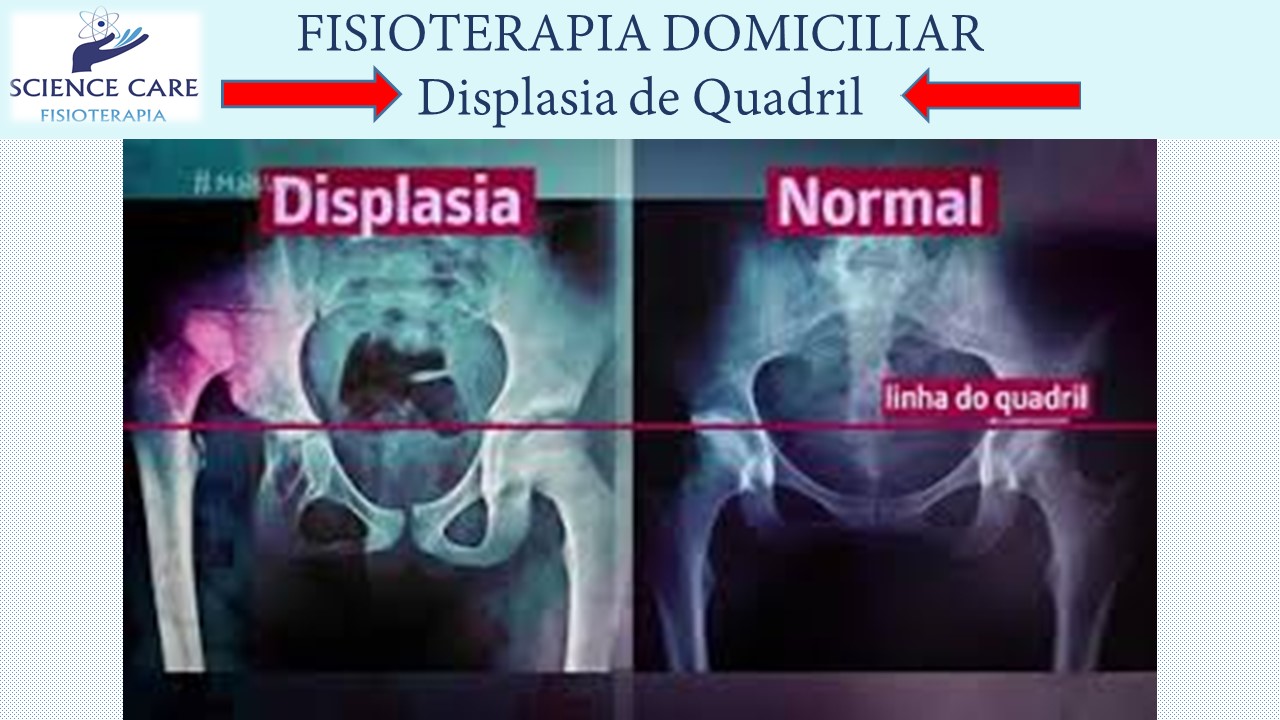 fisioterapia_displasia_quadril