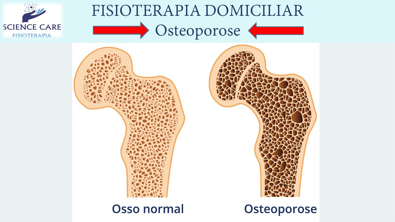 Fisioterapia_Osteoporose